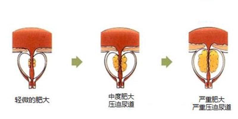泌尿系结石与肾结石有什么区别？