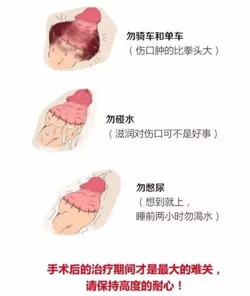 泌尿系结石：如何区分与应对？